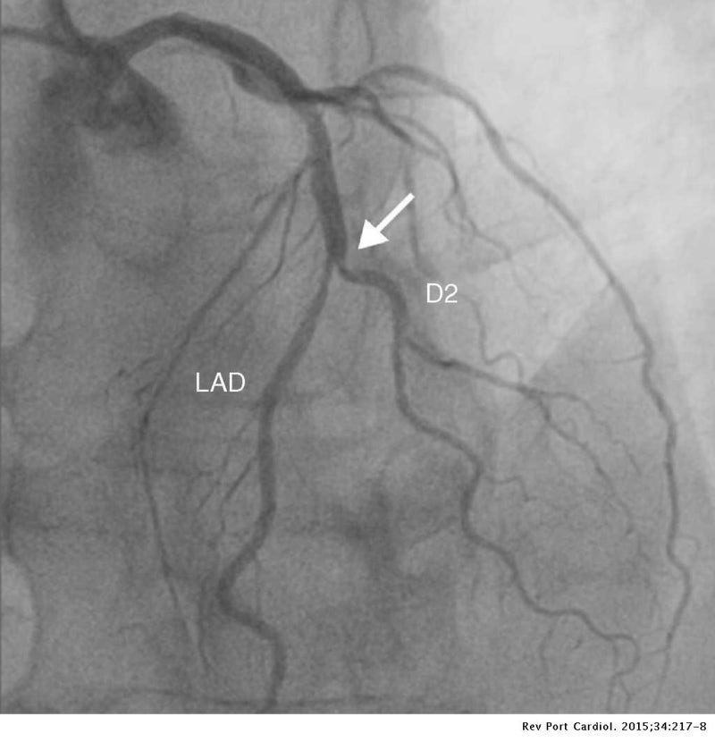 LAD, LCX, RCA 구분하는 법 ; coronary angiograpy 보는 법 : 네이버 블로그