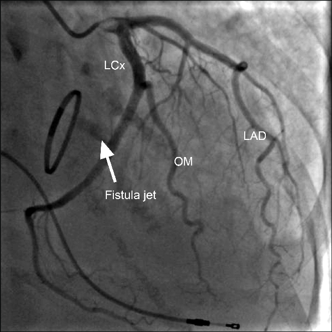 LAD, LCX, RCA 구분하는 법 ; coronary angiograpy 보는 법 : 네이버 블로그