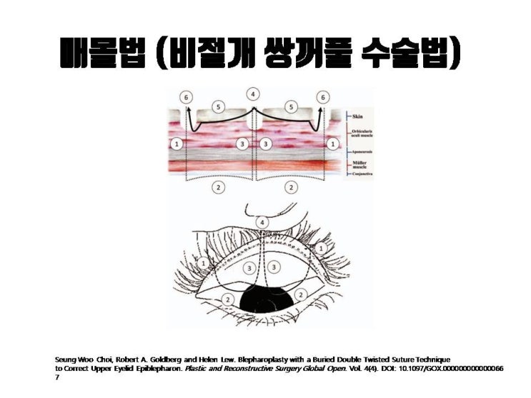  매몰, 자연유착 쌍수 매몰실만 제거한다고 다 풀리는거 아니에요!!!
