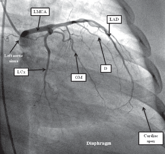 Lad lcx rca coronary angiograpy 