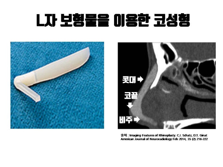 L자 실리콘으로 코성형 받은 경우 코재수술 시 교정해야 할 것도 많아요!!!