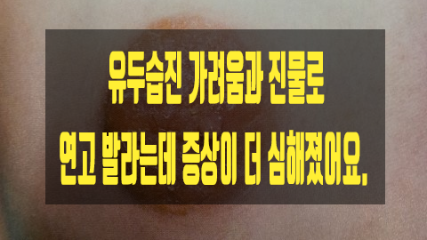  유두습진 가려움과 진물로 연고 발라는데 증상이 더 심해졌어요.