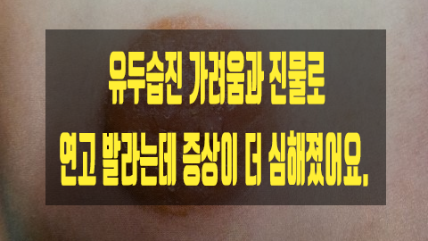 유두습진 가려움과 진물로 연고 발라는데 증상이 더 심해졌어요.