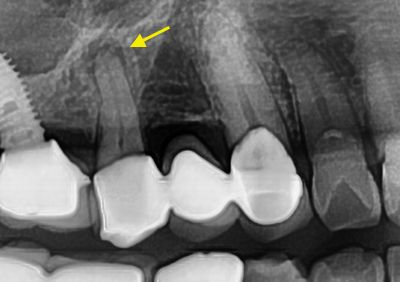 뿌리 끝 염증있는 치아를 신경치료로 살리는 법