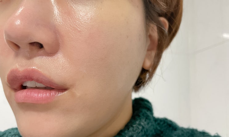  강남역 피부과 튠페이스 받고 2주뒤 후기