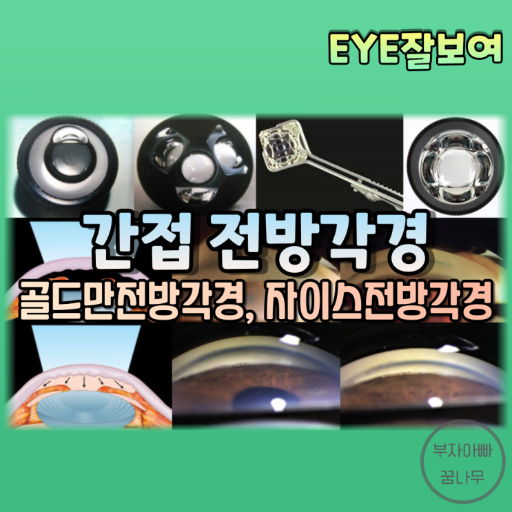  [EYE잘보여] '간접 전방각경(전방각거울, 전방각프리즘)' - 골드만(Goldmann), 자이스(Zeiss)