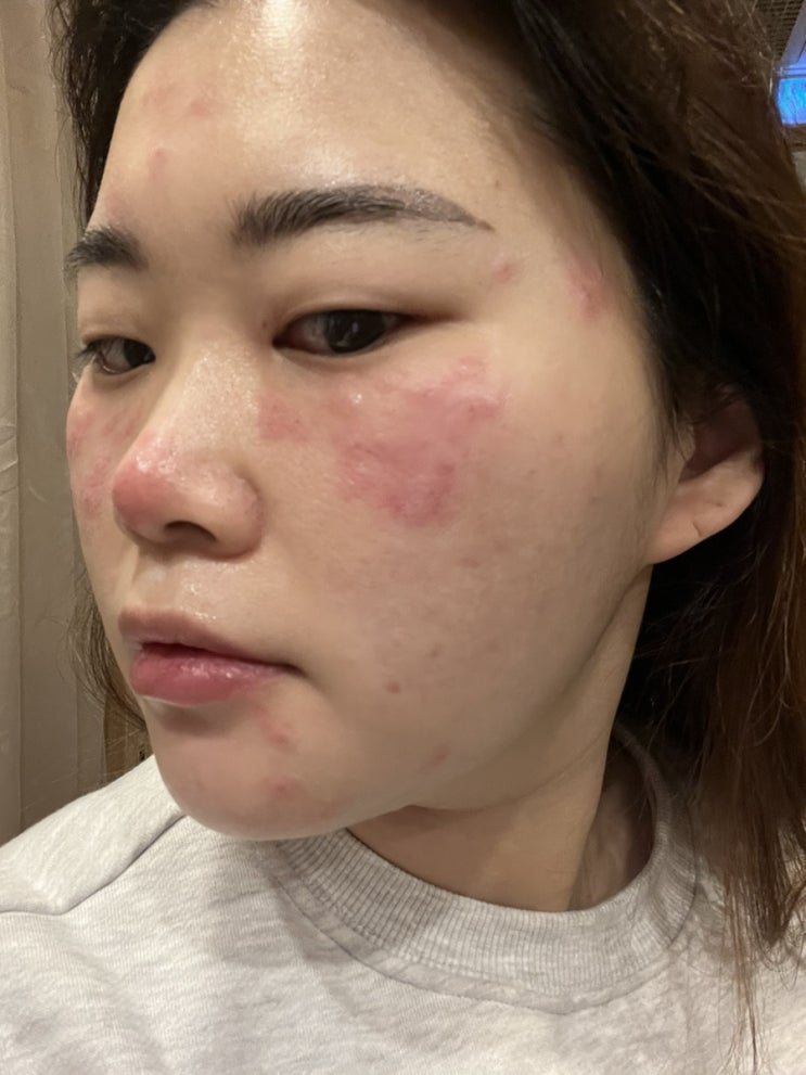  종로피부과 아꼴레이드 레이저토닝 1회차 후기