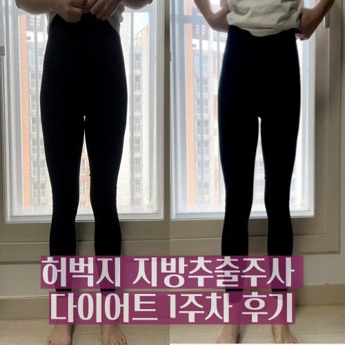  무한람스 허벅지 지방추출주사 다이어트 1주차 (멍, 붓기, 다리변화)