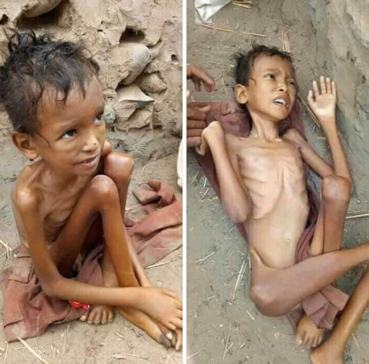  [네이버 해피빈 기부] 영양실조로 싸우는 예멘 아이들을 도와주세요