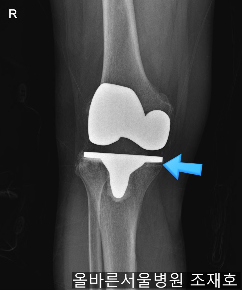 무릎 인공관절 수술의 성공률을 높이는 방법은? 4