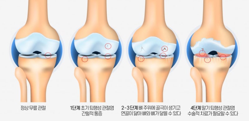 무릎연골주사 효과를 기대할 수 있나요?