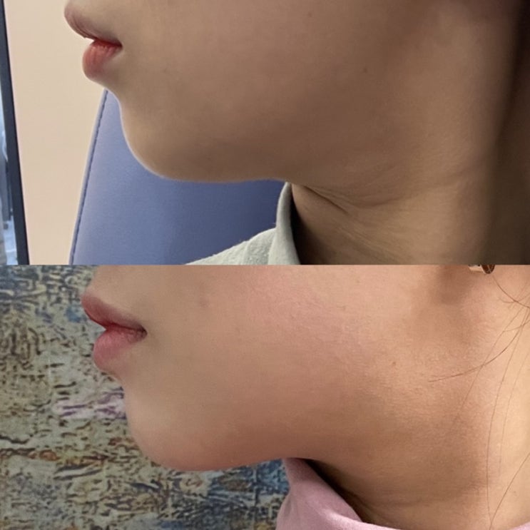  광주윤곽주사 얼굴제로팻 얼굴지방흡입효과 3회차 맞았어요