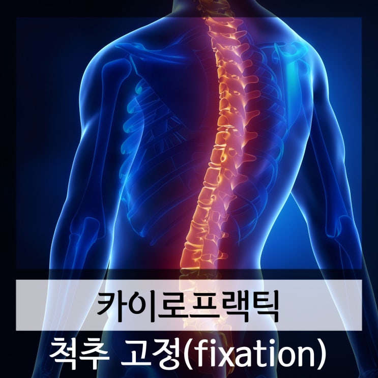  카이로프랙틱 척추의 고정(Fixation)에 의한 양측성 근력약화