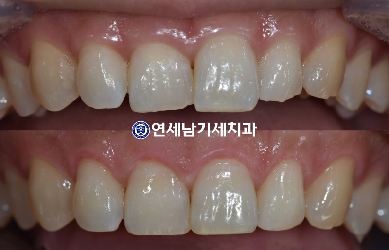 앞니부분교정 비용? 치아 다듬기10분 2
