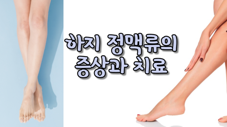  하지 정맥류의 증상과 치료