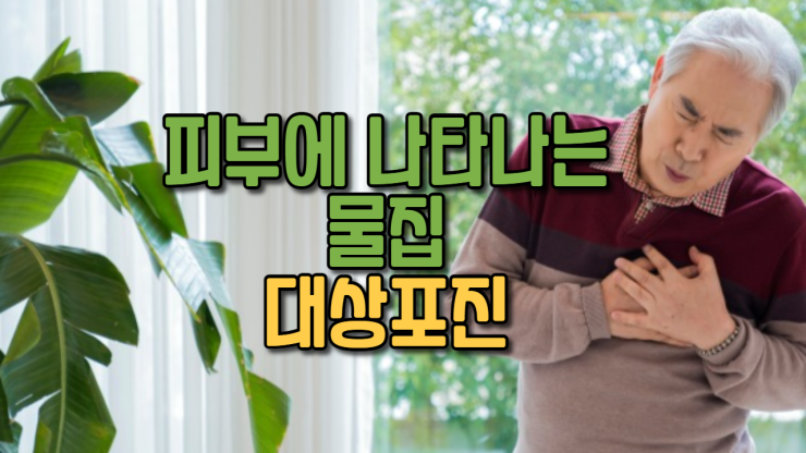  피부에 나타나는 물집 대상포진 (어른)