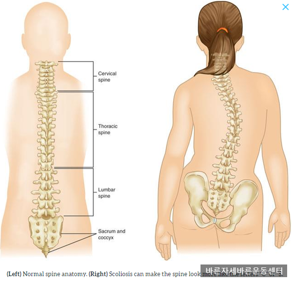  [서래마을PT]척추측만증 교정(누워서 하는 운동 편)