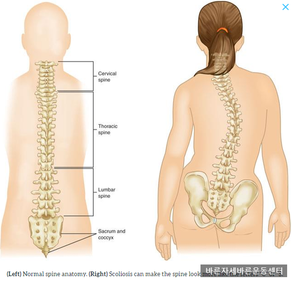 [서래마을PT]척추측만증 교정(누워서 하는 운동 편)