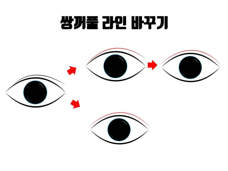  쌍수매몰재수술과 쌍수자연유착재수술로도 교정할 수 있는 게 많아요!!!