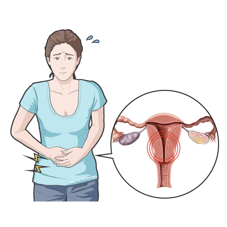  남양주 별내 생리통? 치료가 어렵다는 착각