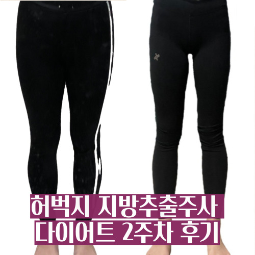  하비탈출 허벅지 안쪽살 지방추출주사 맞고 허틈 만들기