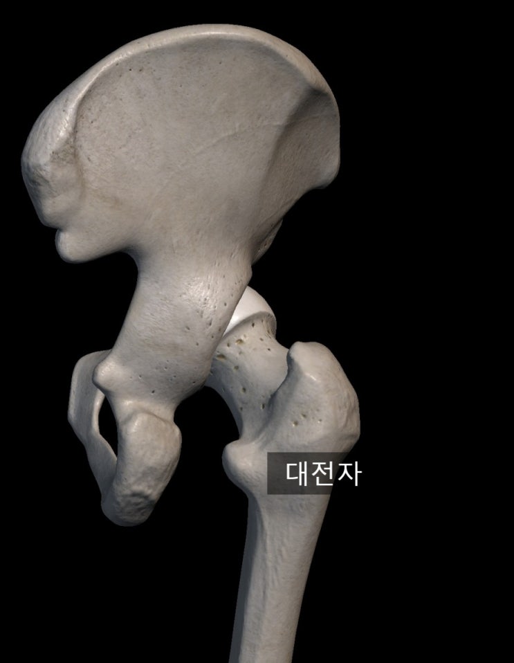 대전자 통증 증후군(Greater trochanteric pain syndrome), 고관절 외측 통증, 엉덩이 외측 통증