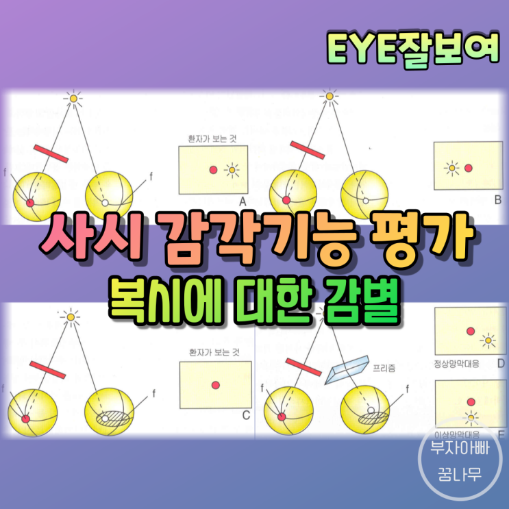  [EYE잘보여] 사시의 감각기능 검사 (1) - 복시(Diplopia)와 시각혼란(Visual Confusion)의 평가
