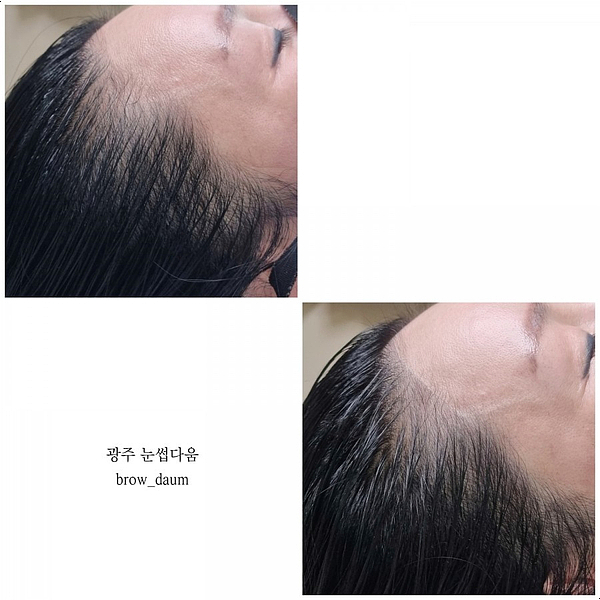  광주헤어라인문신 잘하는곳 예쁜 이마 만들기