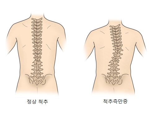  부산 어린이 척추측만증 치료시점과 방법 설명드려요