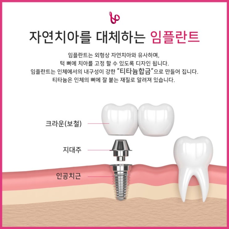  임플란트에 대한 모든 궁금증 해결하기!