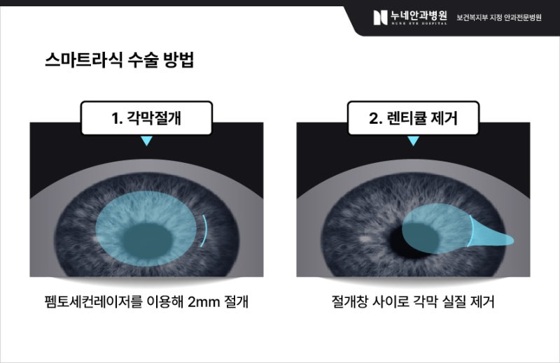 라식 수술 비용은 얼마입니까? 3
