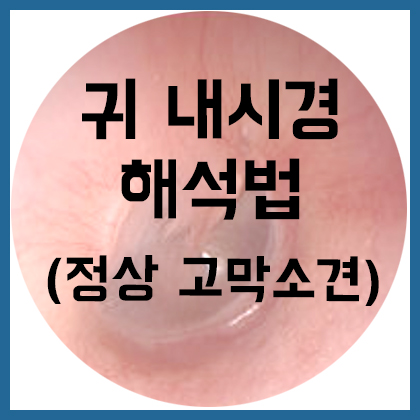  [귀] 귀 내시경 소견 해석법(정상 고막 소견)