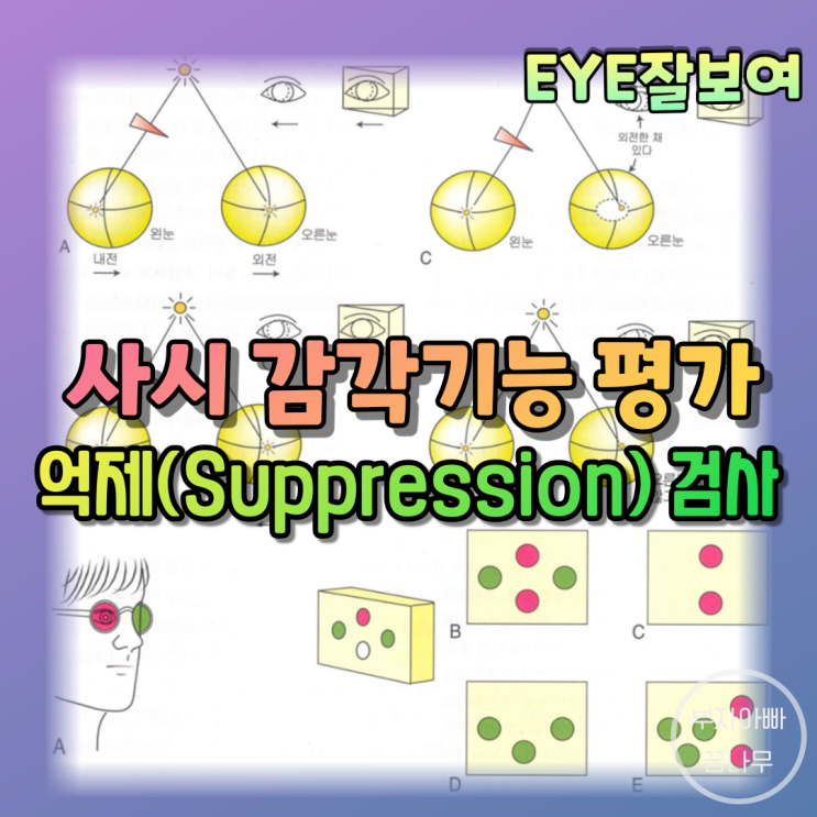 [EYE잘보여] 사시의 감각기능 검사 (2) - 억제(Suppression)