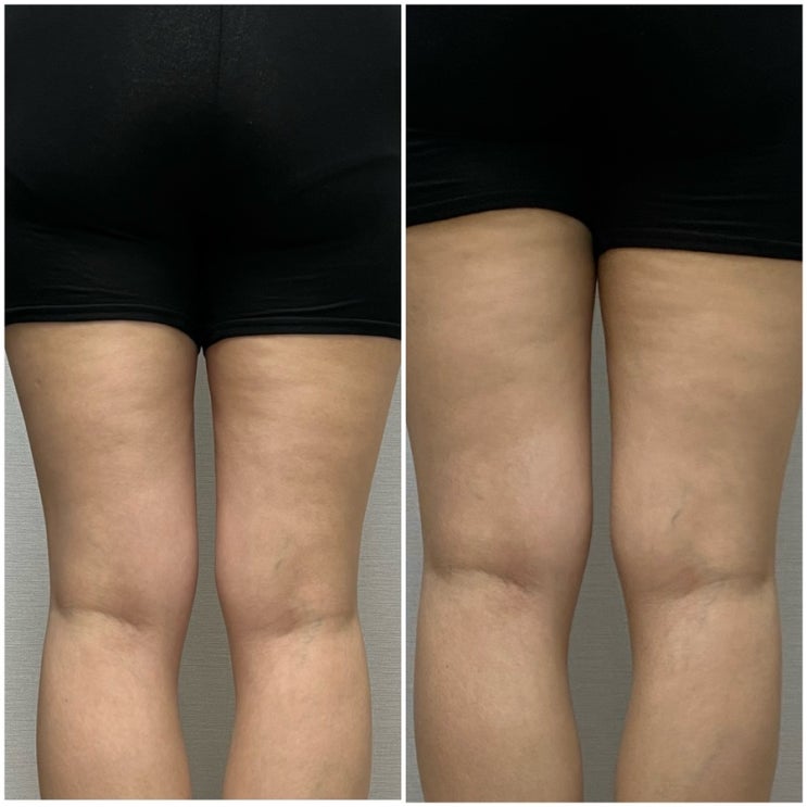부산다이어트병원 mpl주사맞고 팔뚝라인 예뻐지기