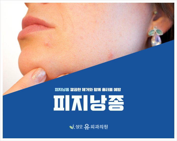 평택피지낭종 깔끔한 제거 하고 싶다면