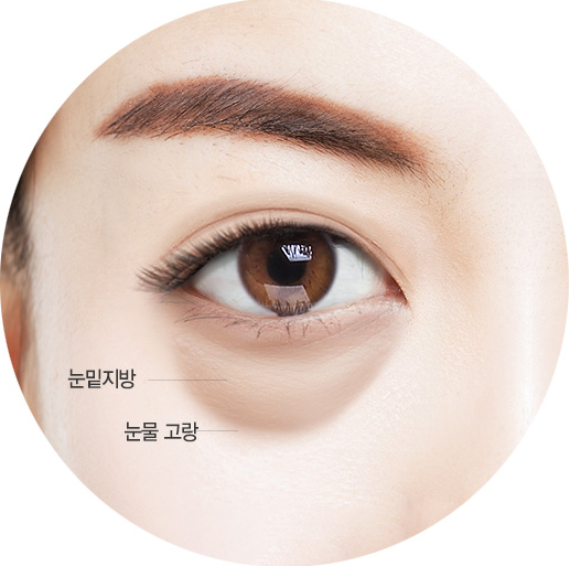 Bucheon Eye의 재배치 수술에 대해 생각하고 있다면