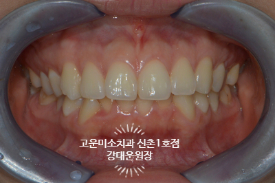  [성인교정]입술돌출과 과개교합
