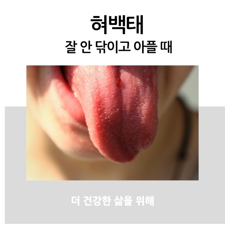  혀 백태 잘 안 닦이고 아플 때