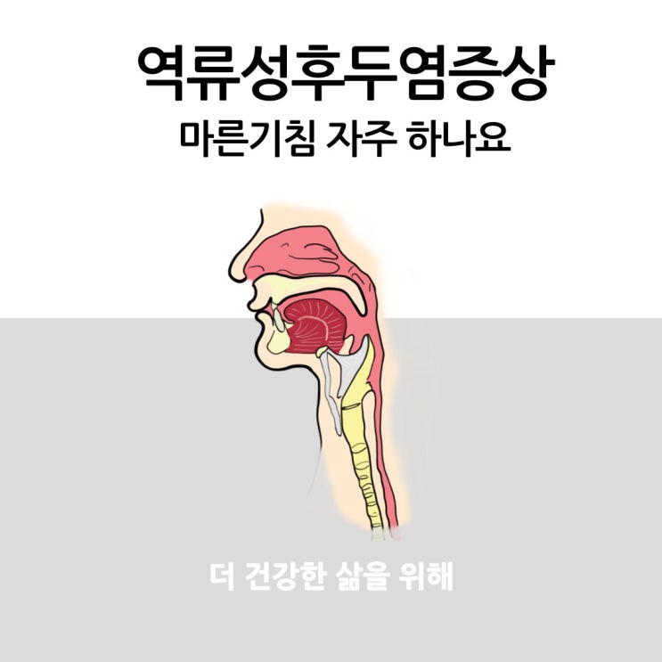  역류성 후두염 증상 마른기침 자주 하나요?