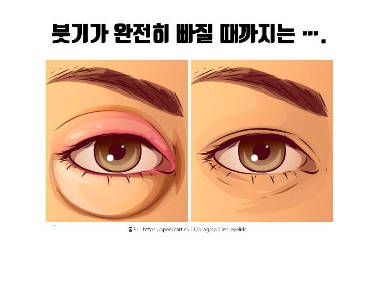  쌍수 후 OO지났는데 소세지 쌍꺼풀이 된 것 같아요? ㅠㅠ