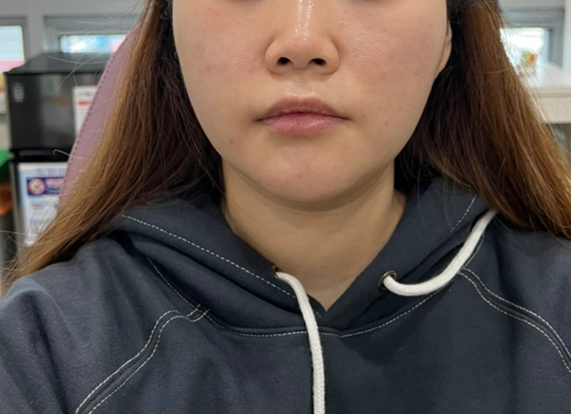  잠실피부과 / 문정역피부과 <물광톡신> 후기