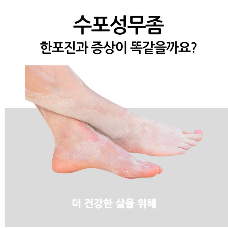  수포성 무좀 한포진과 증상이 똑같을까요?