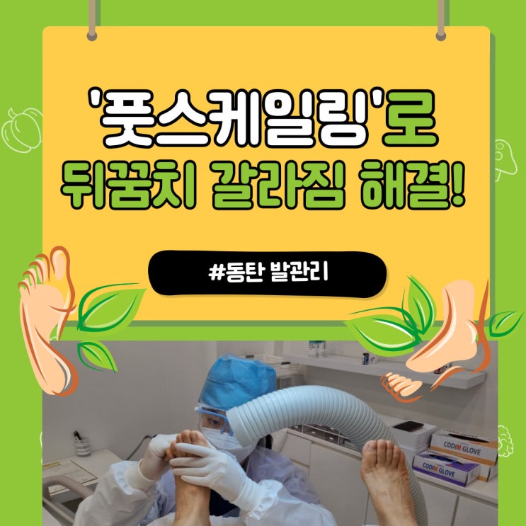  동탄 발관리 레푸스 뒤꿈치 갈라짐은 풋스케일링으로!