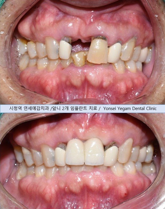  [서울시청역/서울역] 앞니 임플란트 가능할까요? 앞니 내비게이션임플란트