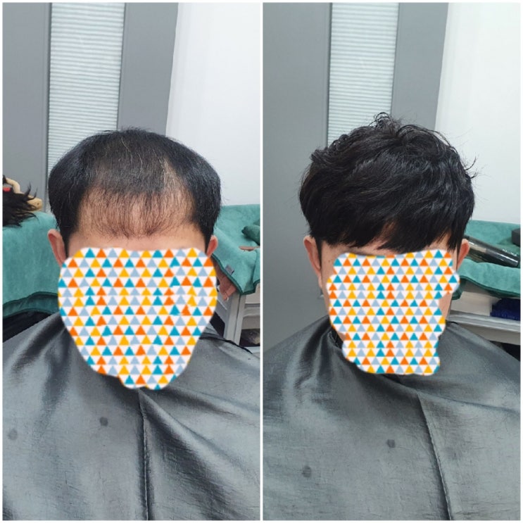  보톡스증모술 아직도 모르세요?춘천가발전문점 안하면 손해!가발덕후 은주누나가 알려드려요~^^