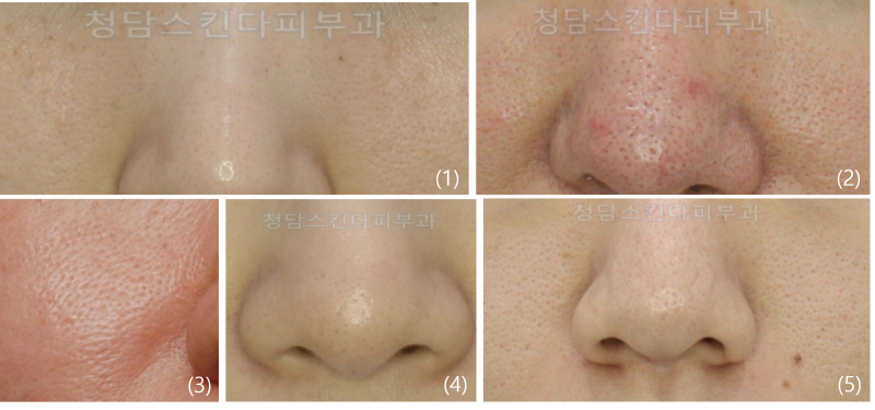 왕십리 피부과 피코 프락셀 레이저 | 마스크 착용으로 커진 코 모공과 여드름 흉터 치료에! 5
