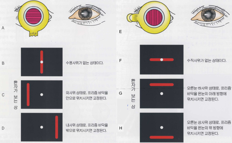 [EYE잘보여] 두 개로 보일 때는 어떤 검사를? - 복시검사(Diplopia Test) : 네이버 블로그