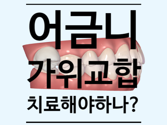 지식인 상담소) 영구치 어금니 가위교합(scissorbite) 교정치료해야 하나요? 치료 방법 지식인 상담소) 영구치 어금니 가위교합(scissorbite) 교정치료해야 하나요? 치료 방법