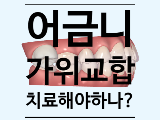 지식인 상담소) 영구치 어금니 가위교합(scissorbite) 교정치료해야 하나요? 치료 방법