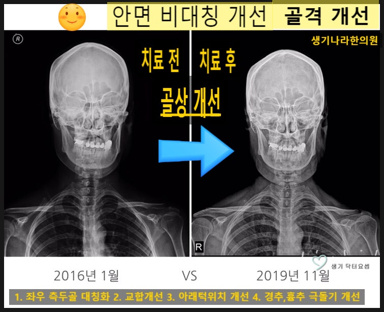 안면비대칭상담 2023년 1월 17일 생기나라 FCST 턱관절 밸런스 의학치료